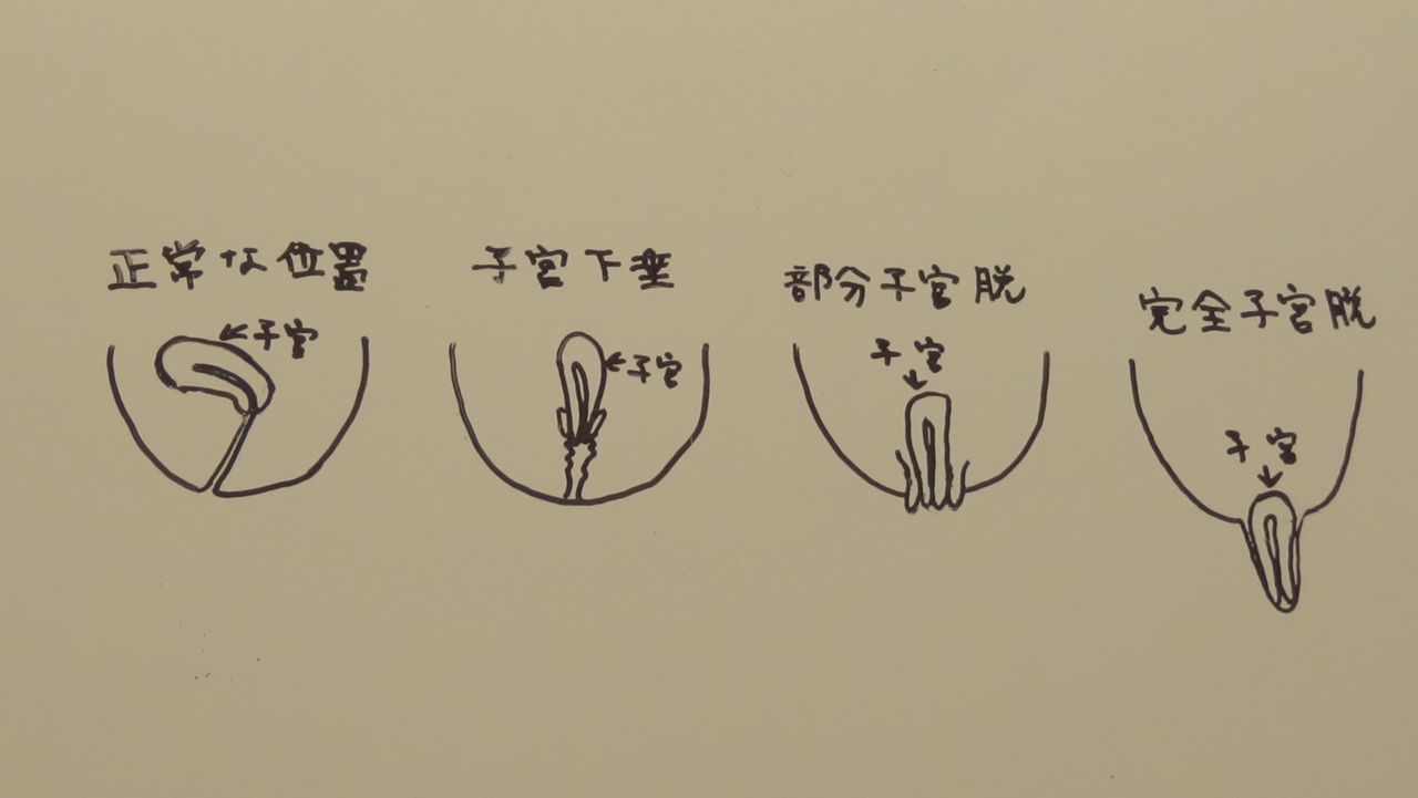 子宮筋腫 粘膜下筋腫 筋腫分娩 子宮脱 後編 第3話 なに ゚d゚ これ 怖い 便秘が原因で 子宮脱 しきゅうだつ に 貧困女子の筋腫分娩 体験日記 子宮筋腫 粘膜下筋腫 筋腫分娩 子宮脱 後編 第3話 なに ゚d゚ これ 怖い 便秘が原因で 子宮脱 しきゅうだつ に 貧困女子の筋腫分娩 体験日記