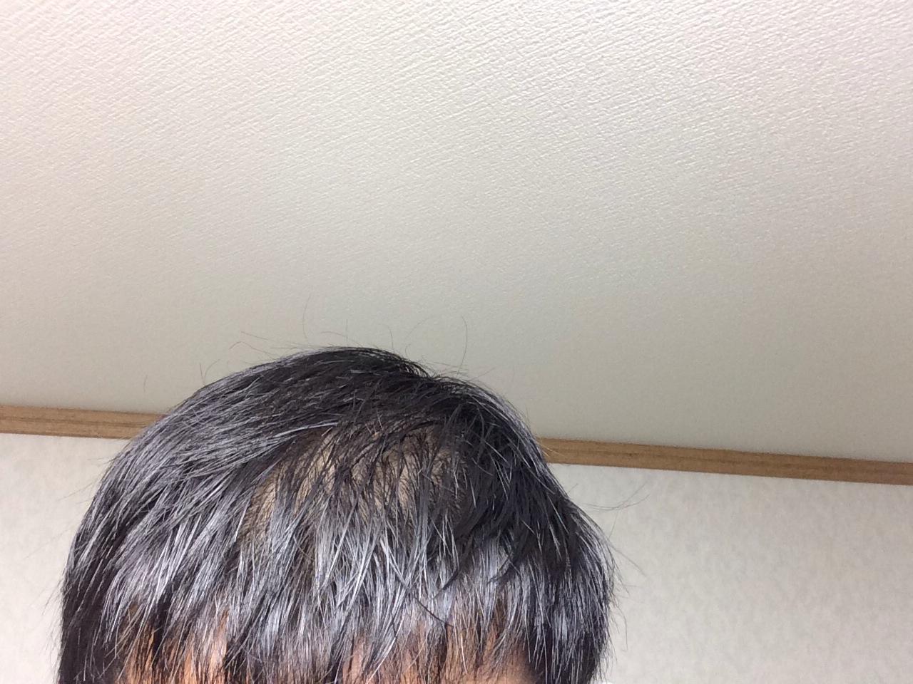 代なのに薄毛 若ハゲで悩んでる人 自 由 を コントロール