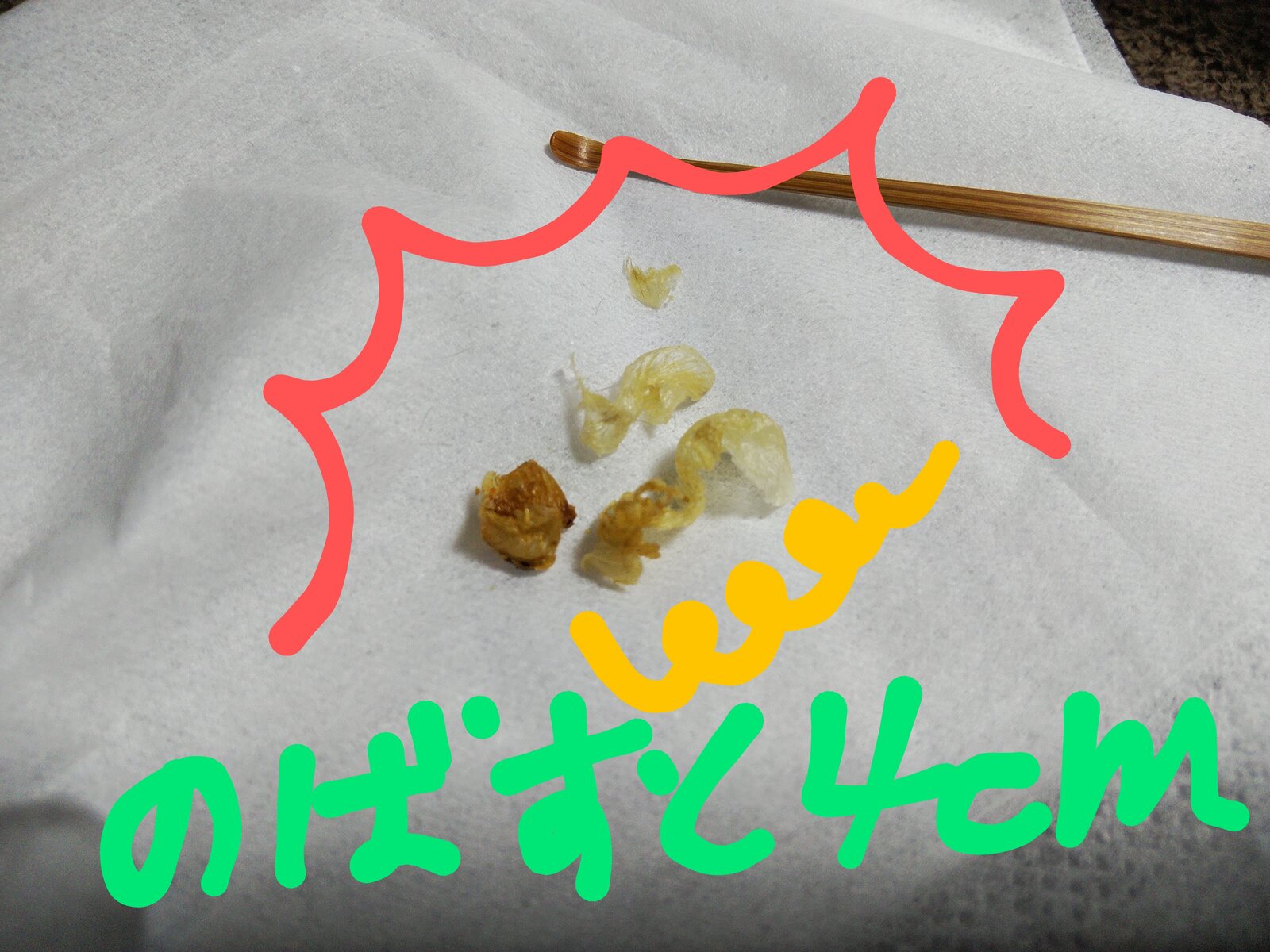 閲注 ぐるぐる巻き貝 耳垢 閲覧注意 ｲﾔｰｴｽﾃ Manis 耳職人孤高の耳かき師梨々花プロの神髄
