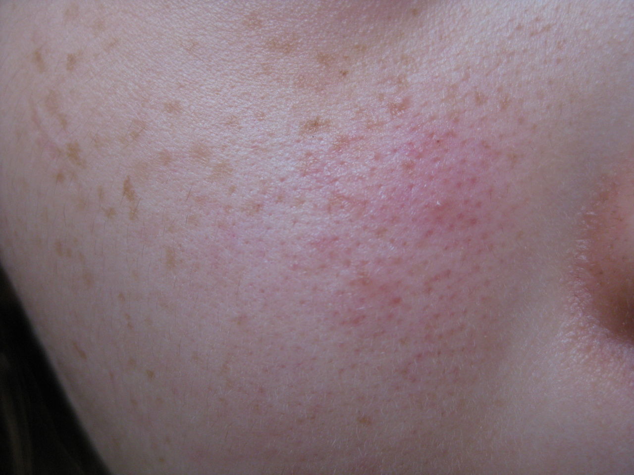 美容 肌汚いjkだけど毎日が地獄すぎワロタwwwwwww 女子力upまとめ キレ速