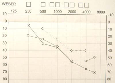 audiogram151208