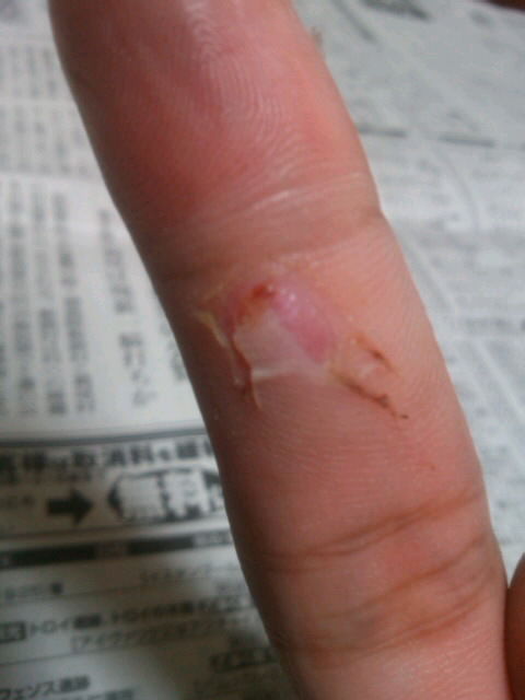 右手中指の切傷 その後 何が多いblogですか