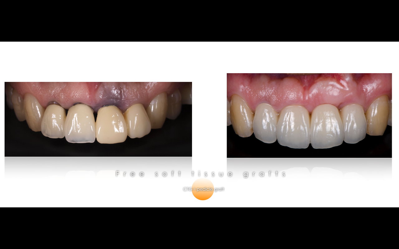 歯グキの黒ずみがレーザーで直らなかった方へ 北インター歯科クリニック 院長ブログ