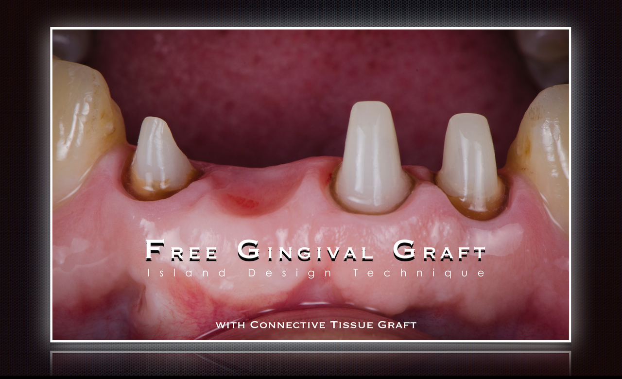 歯グキの黒ずみがレーザーで直らなかった方へ 北インター歯科クリニック 院長ブログ