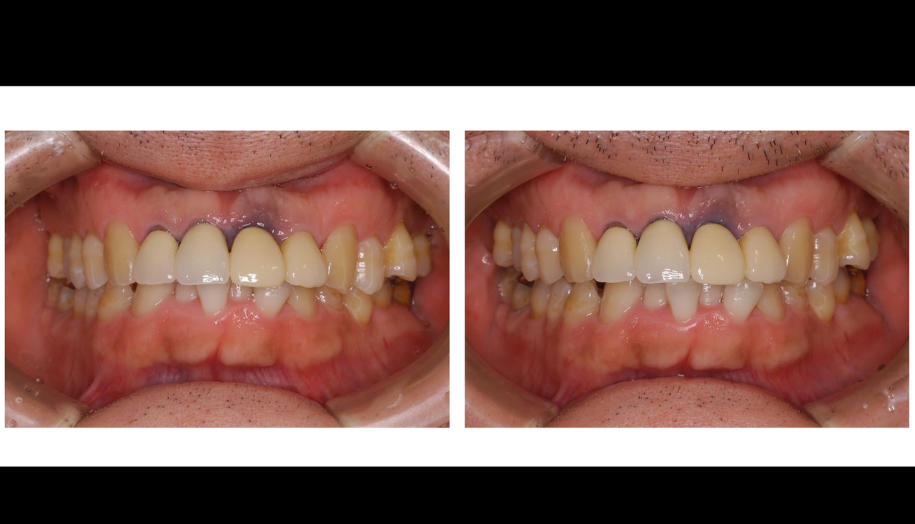 歯グキの黒ずみがレーザーで直らなかった方へ 北インター歯科クリニック 院長ブログ