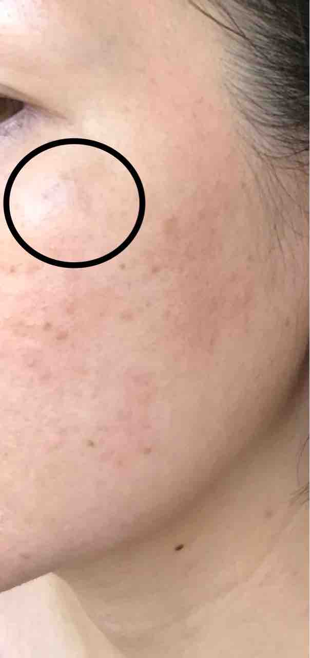 シミのレーザー治療の結果 食生活日記