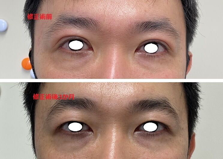 二重ライン幅を狭くする 一重まぶたにしたい 目の開きを悪くしたい 眼瞼下垂手術後の修正 美容外科医 Dr上のブログ タウン形成外科クリニック のblog 二重ライン幅を狭くする 一重まぶたにしたい 目の開きを悪くしたい 眼瞼下垂手術後の修正 美容外科医 Dr上のブログ タウン形成外科クリニック のblog