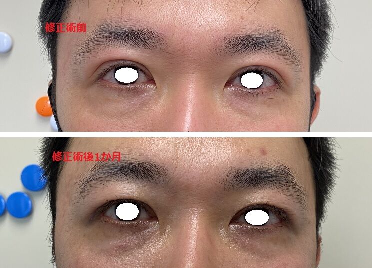 二重ライン幅を狭くする 一重まぶたにしたい 目の開きを悪くしたい 眼瞼下垂手術後の修正 美容外科医 Dr上のブログ タウン形成外科クリニック のblog