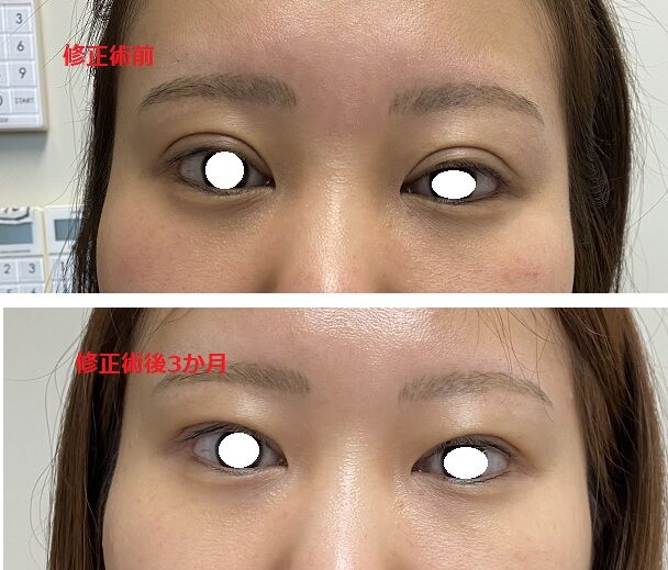 二重ライン幅を狭くする 目の開きの左右差も改善した症例 美容外科医 Dr上のブログ タウン形成外科クリニック のblog 二重ライン幅を狭くする 目の開きの左右差も改善した症例 美容外科医 Dr上のブログ タウン形成外科クリニック のblog