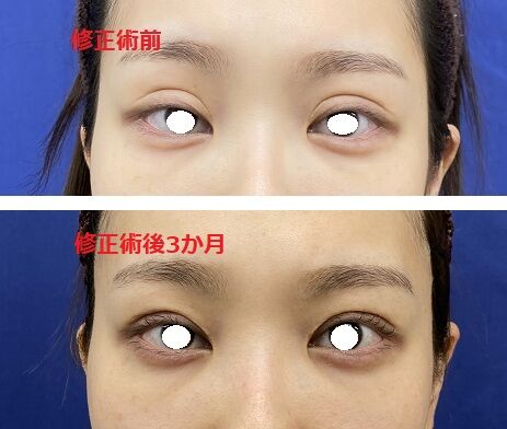 二重ライン幅を狭くする 眼瞼下垂手術を行わなくても目の開きが改善した症例 美容外科医 Dr上のブログ タウン形成外科クリニック のblog 二重ライン幅を狭くする 眼瞼下垂手術を行わなくても目の開きが改善した症例 美容外科医 Dr上のブログ タウン形成外科クリニック のblog
