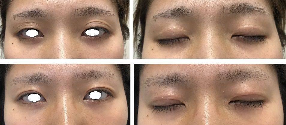 二重ライン幅を狭くする 予定外重瞼線も消しました 美容外科医 Dr上のブログ タウン形成外科クリニック のblog 二重ライン幅を狭くする 予定外重瞼線も消しました 美容外科医 Dr上のブログ タウン形成外科クリニック のblog