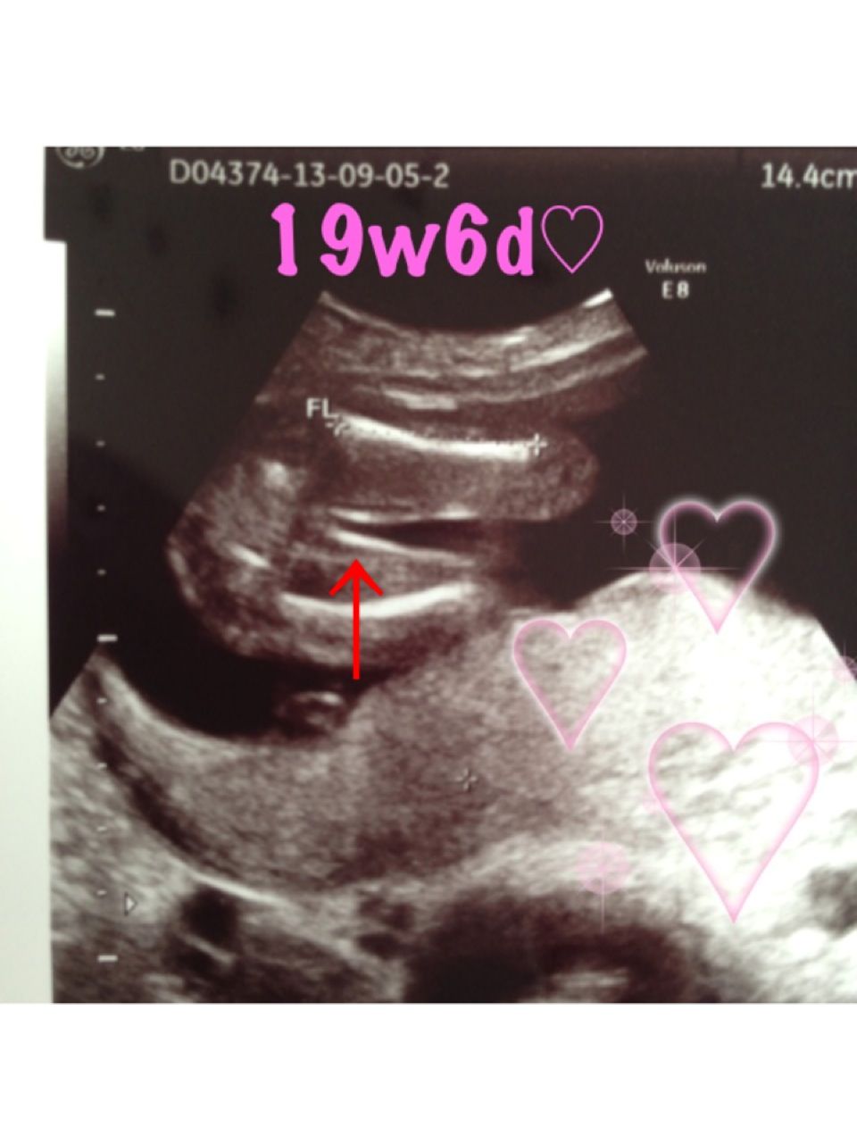 19w6d 妊婦健診 性別 Girl Girl 19w6d 妊婦健診 性別 Girl Girl
