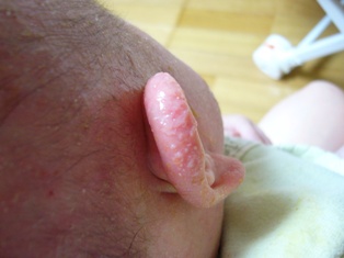 湿疹通信 わたしのせいかつ