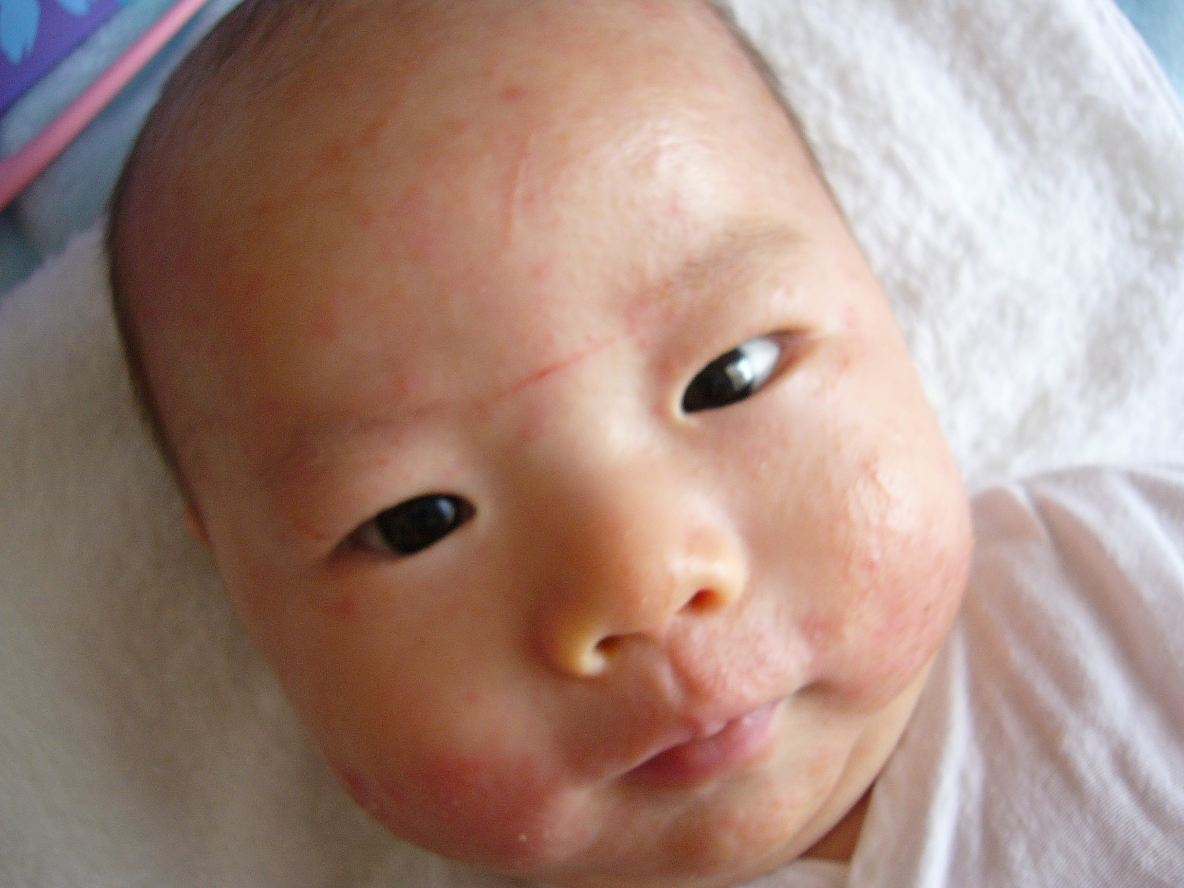 さて 湿疹ですけど わたしのせいかつ