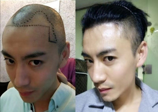 20191001_hair-transplant_SCMP