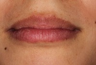 Before-LipEsthe