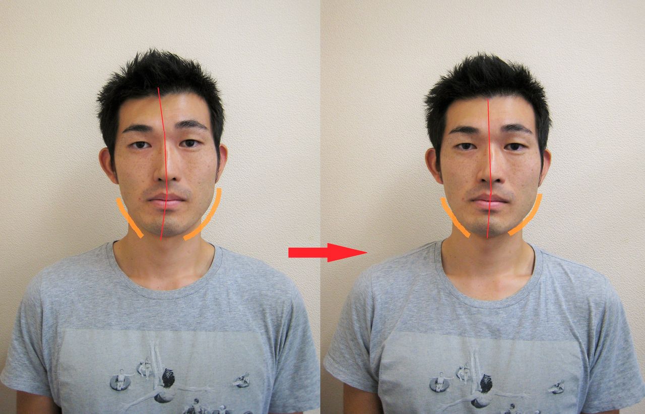 男性の顔の歪み小顔矯正 静岡で痛くない 元に戻らない 小顔矯正 男性の顔の歪み小顔矯正 静岡で痛くない 元に戻らない 小顔矯正