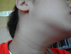 喉が腫れた日 外が晴れた日 みこみこぷん