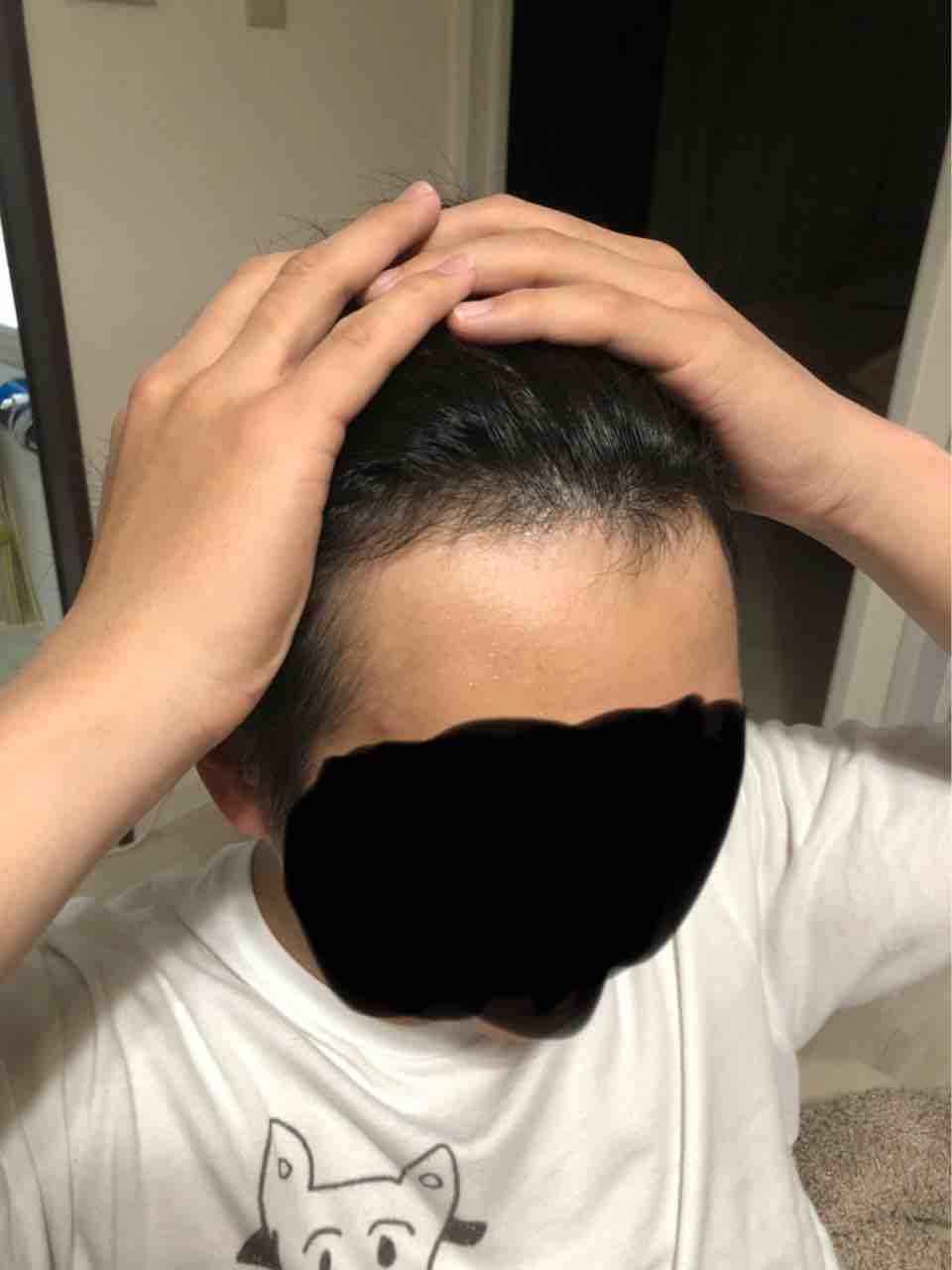 ハゲbefore After ウェンディーズとドムドム