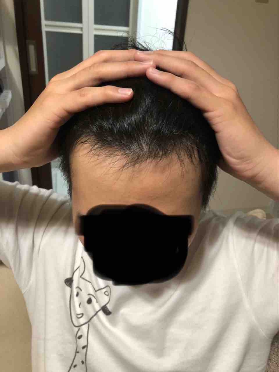 ハゲbefore After ウェンディーズとドムドム ハゲbefore After ウェンディーズとドムドム