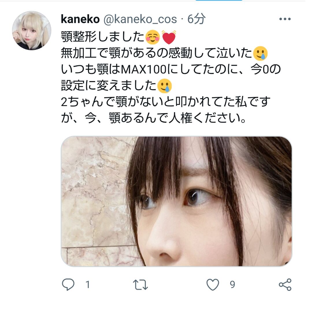 画像 2ちゃんで 顎なし といじめられた女性 顎出し手術に成功ｗｗｗｗｗ 美味しい毒