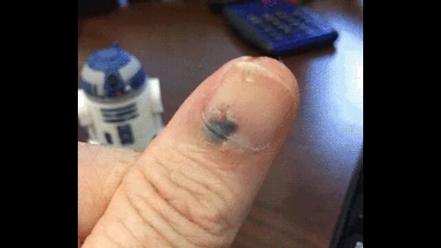 黒く内出血した爪が移動する様子を撮影し続けた早回し映像が面白い