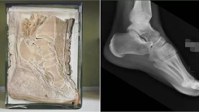ゾウの足と人間の足、足首から下の骨格はだいぶ似てるぞというレントゲン写真