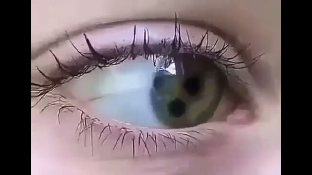 ひとつの眼球に瞳孔が複数できる稀な疾患、多瞳孔症