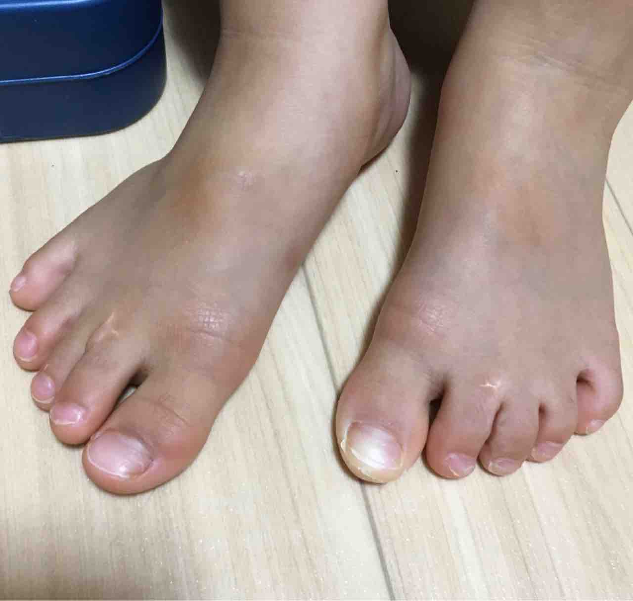 足の指が くっついて生まれてきた息子 手術から2年経った え 発達障害かも と言われても こたママナースの迷走ブログ 足の指が くっついて生まれてきた息子 手術から2年経った え 発達障害かも と言われても こたママナースの迷走ブログ