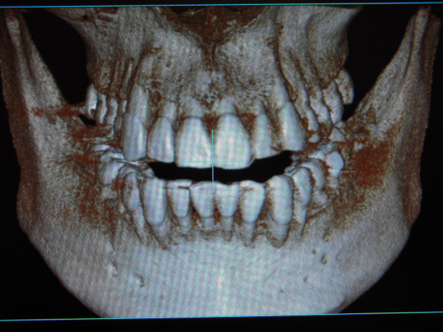 骸骨でこんにちは の話し 生涯歯医者 ブランパパのメモ