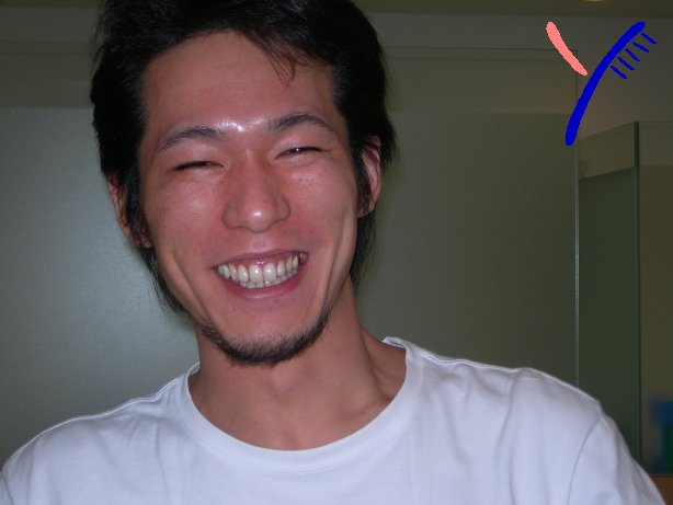 歯が小さい のお話し 生涯歯医者 ブランパパのメモ