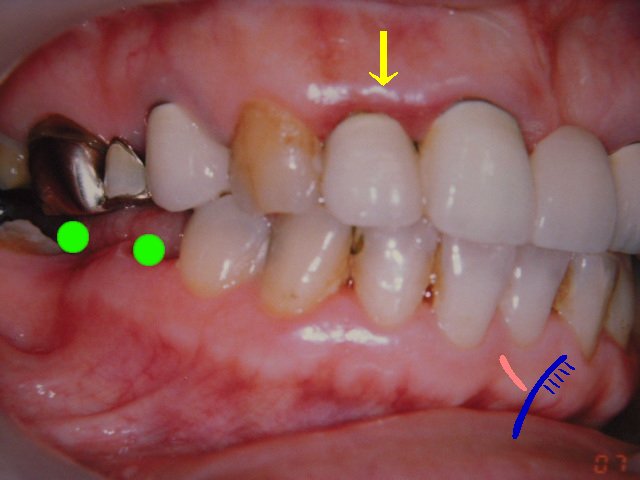 修復冠セラモメタルと歯肉の発赤 の話し 生涯歯医者 ブランパパのメモ