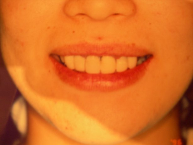 笑うと歯茎が見えて気になる 話し ガミースマイル 生涯歯医者 ブランパパのメモ