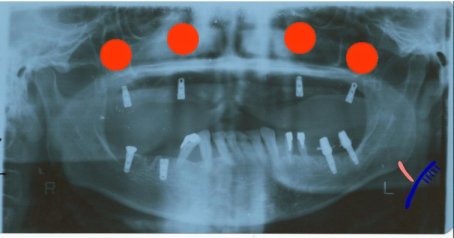 ץȼ-Non flap OP.