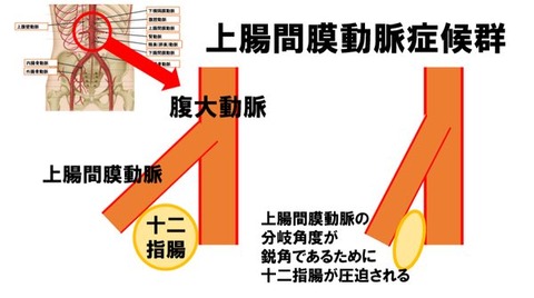 錠腸間膜症候群ー１
