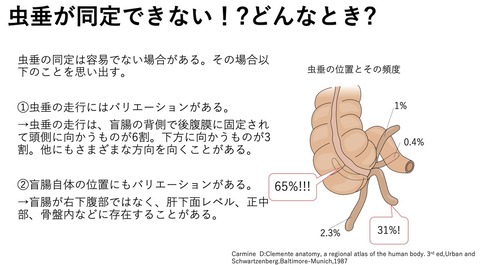 虫垂の位置　－１