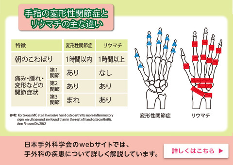 関節リウマチと変形性関節症の違いー１