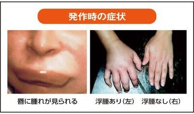 血管性浮腫　　－－１