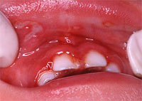 ヘルペス性歯肉口内炎の写真画像