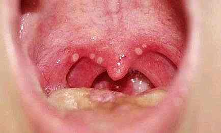 アフタ性口内炎(喉)の画像