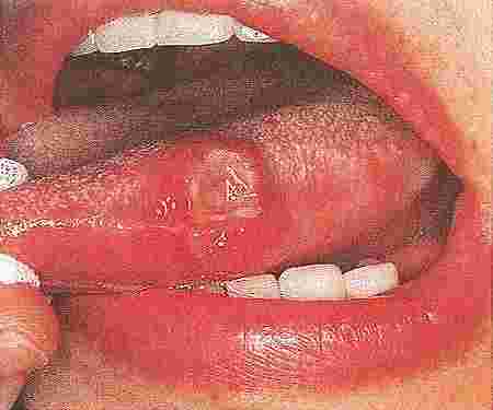 アフタ性口内炎(舌炎)の画像