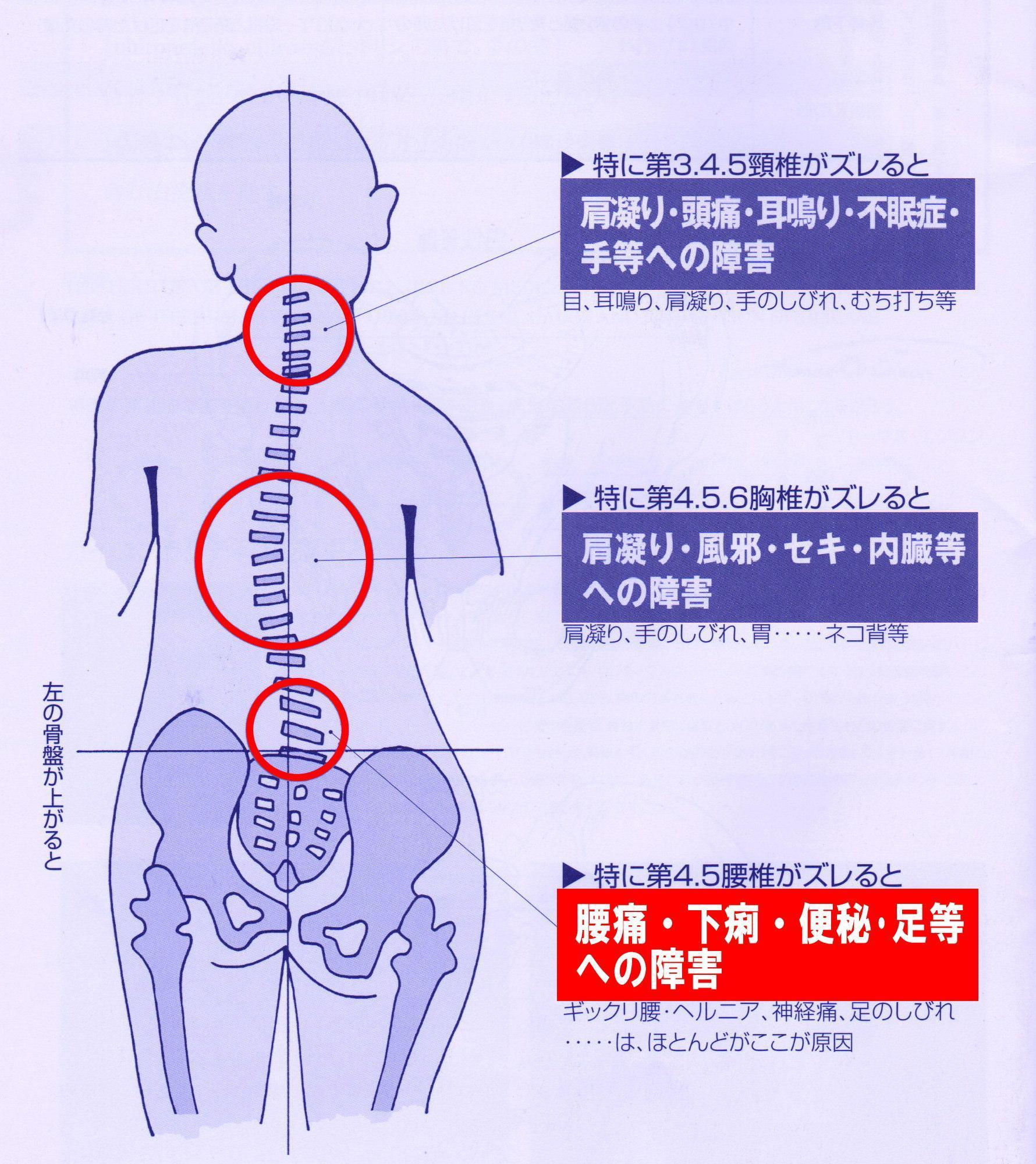 腰痛 腰の痛みには 骨盤矯正 オダサガにある光線治療のマルキ 腰痛 腰の痛みには 骨盤矯正 オダサガにある光線治療のマルキ