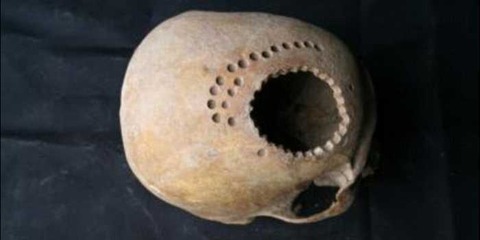 ペルーの古代アンデスの頭蓋骨手術