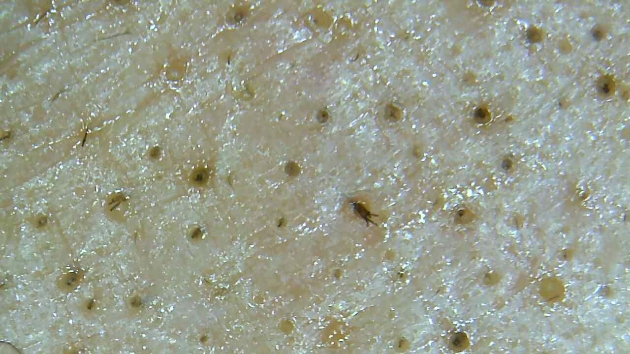 19年11月10日 ケミカルピーリング 顔脱毛体験