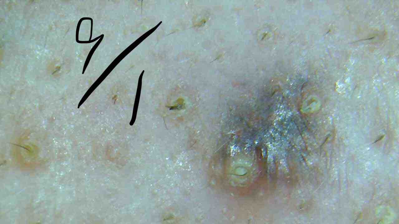 皮脂 ケミカルピーリング 顔脱毛体験