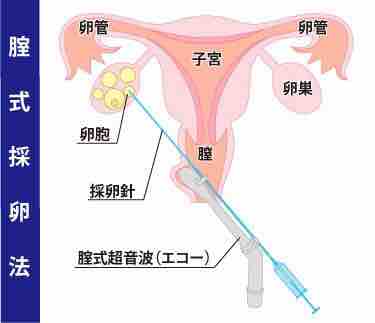 身体的な不妊治療の辛さ コウノトリ来てくれるかな