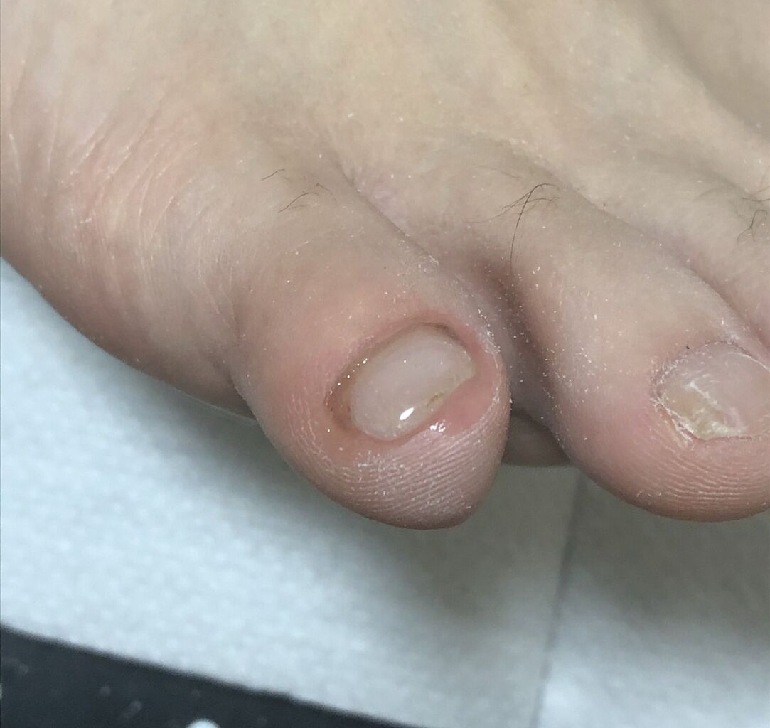 音楽生活 爪を治してもらいました たいこもちブログ