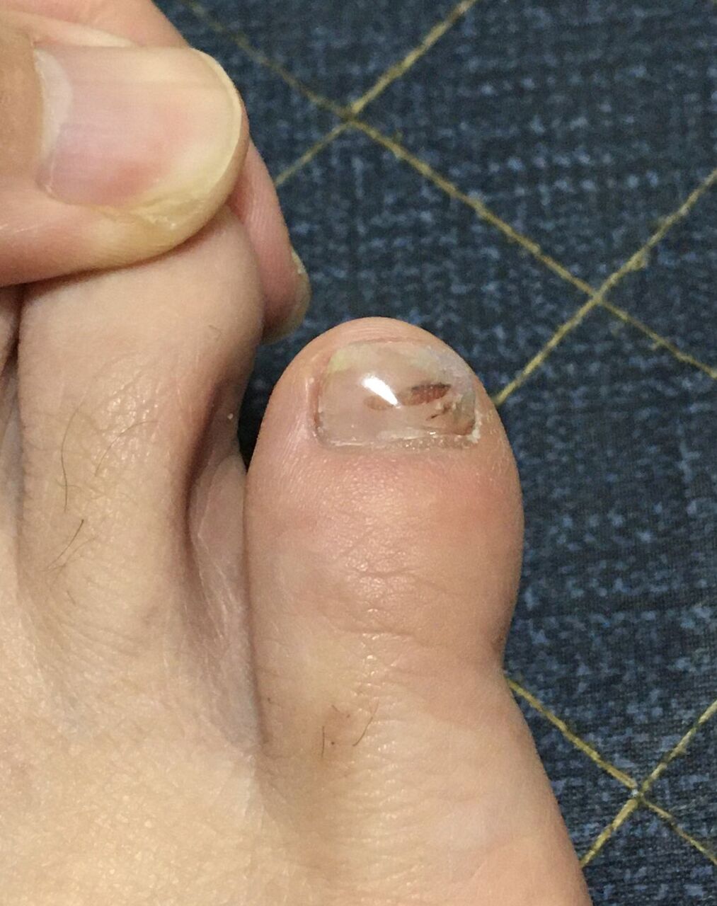 音楽生活 爪を治してもらいました たいこもちブログ