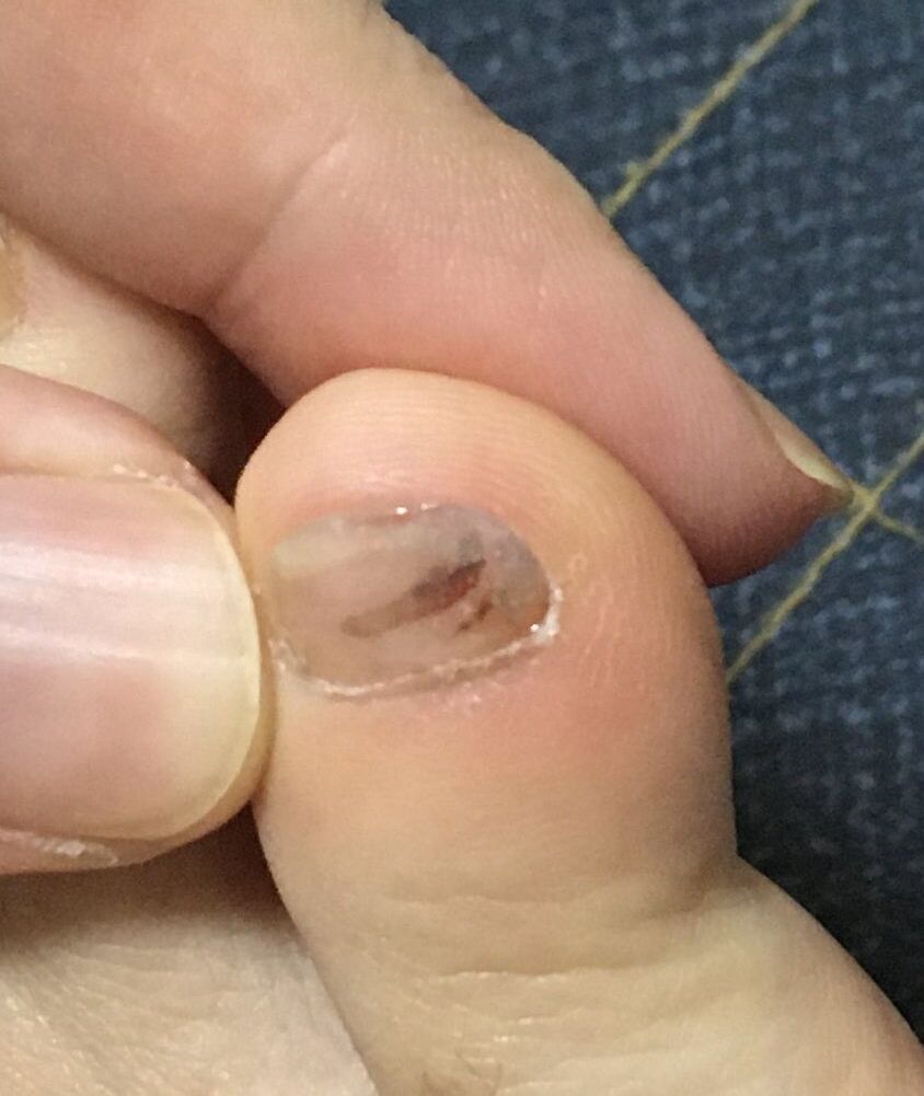 音楽生活 爪を治してもらいました たいこもちブログ