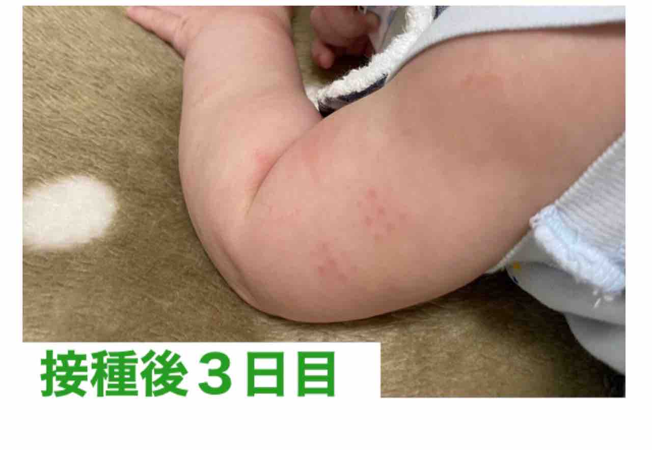 g接種後 3日目 飽き性サブレの育児ブログ g接種後 3日目 飽き性サブレの育児ブログ